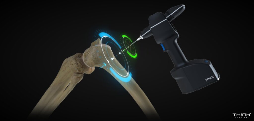 Image montrant l'appareil chirurgical orthopédique THINK Surgical.